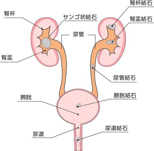 尿路結石症 - かわい泌尿器科クリニック（山口県防府市）